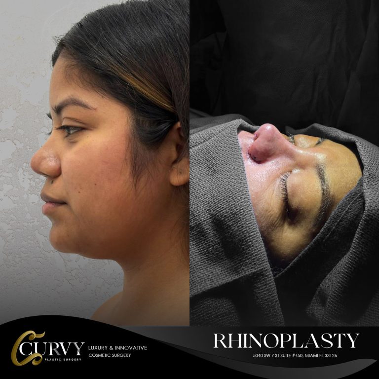 rhinoplasty