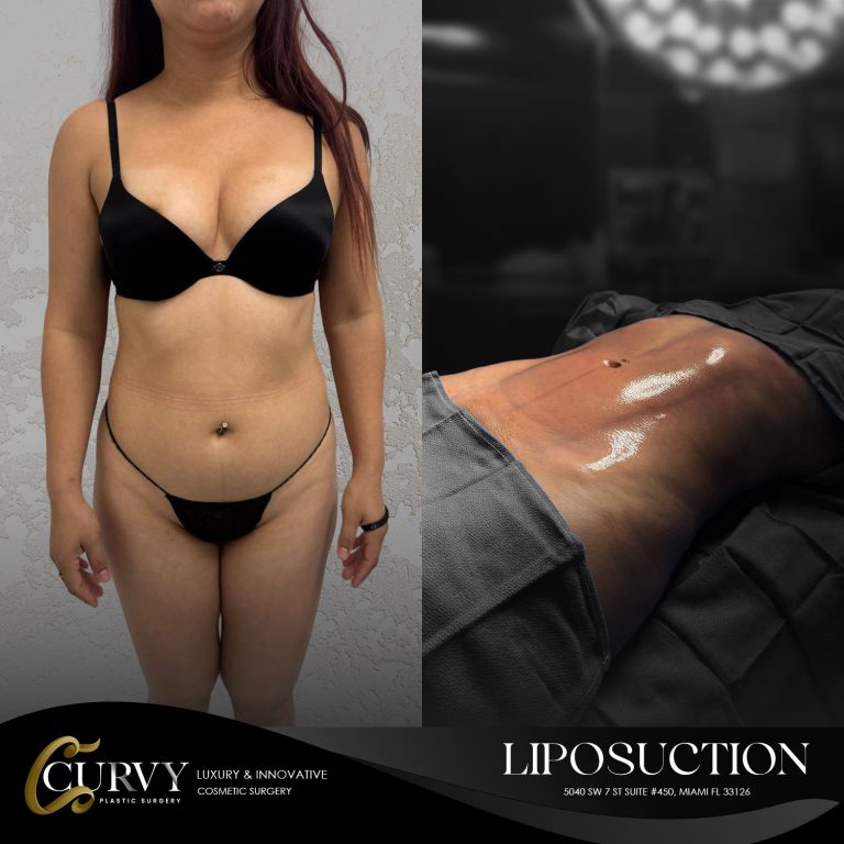 liposuction