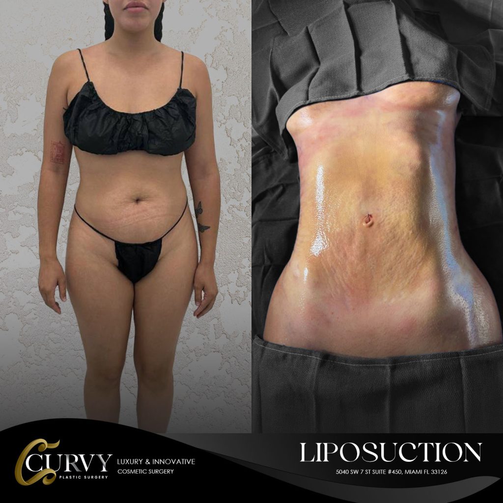 curvy_lipo (2)