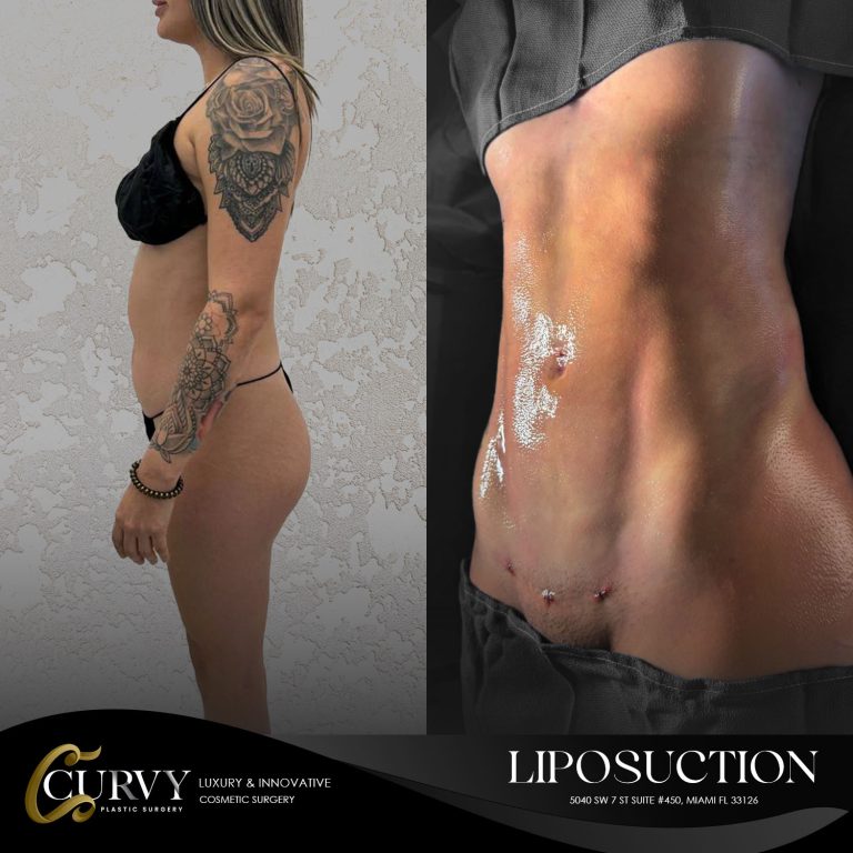 curvy_lipo (3)
