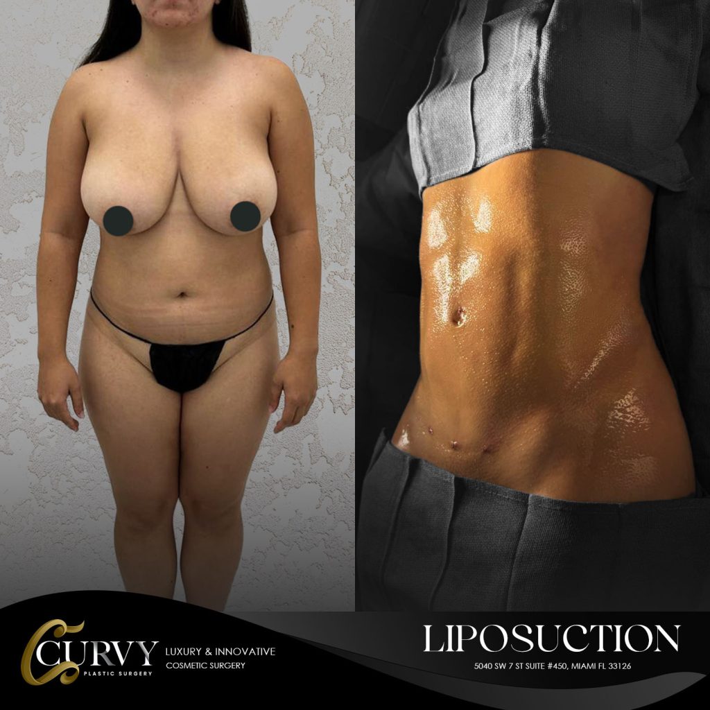 curvy_lipo (4)