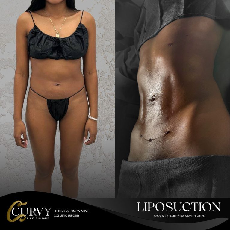 curvy_lipo (6)